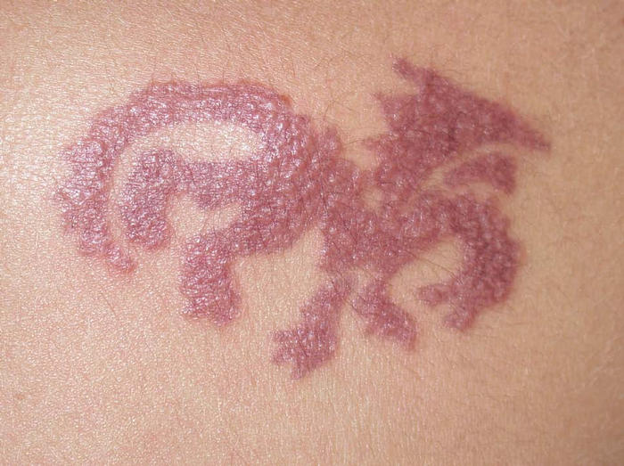 Los tatuajes de Henna, una moda con riesgos.Consulta de Pediatría Dr Canals